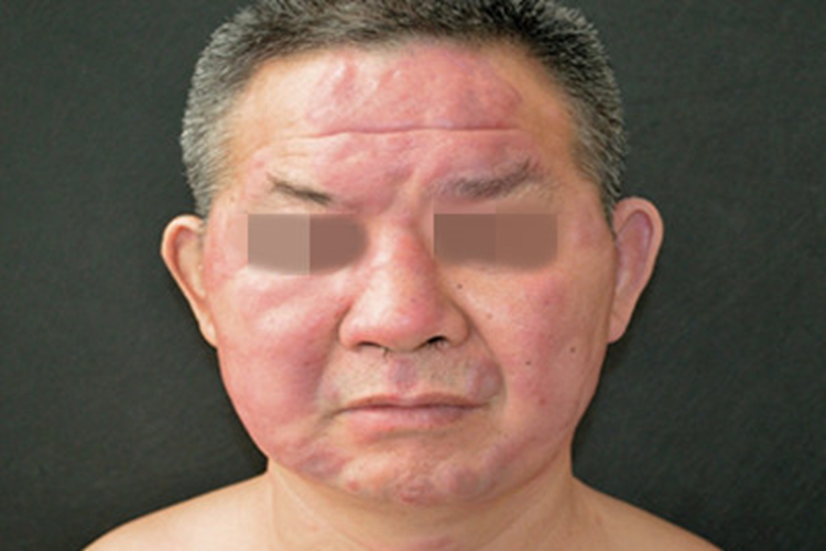 瘤型麻风面部红斑图