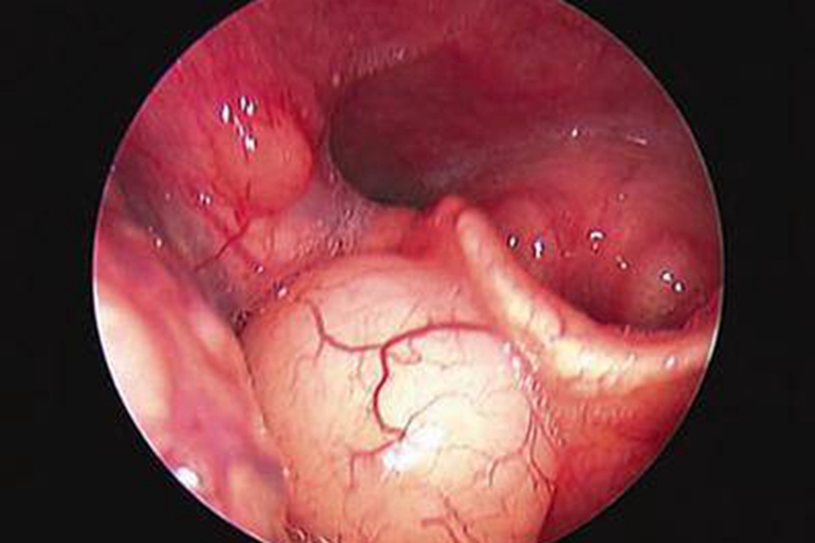 马齿苋过敏喉部肿胀图