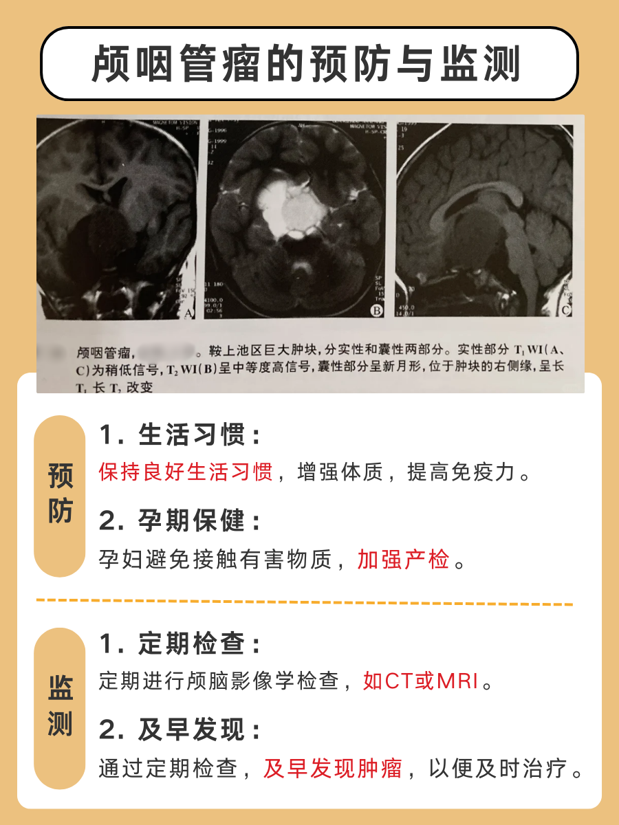 颅咽管瘤,会“留”给下一代吗?