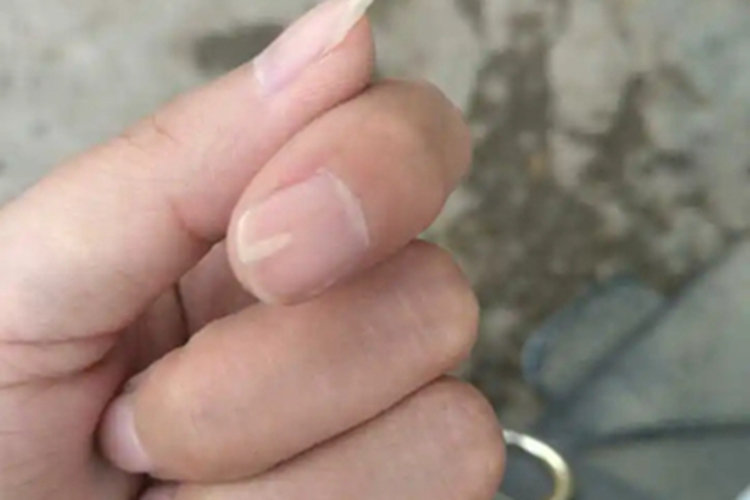 甲纵裂食指有白色竖纹图