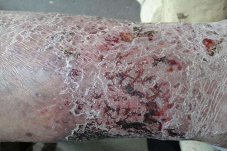淤积性皮炎小腿发红图