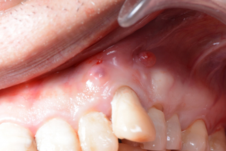 口腔牙龈肉芽肿图 口腔牙龈肉芽肿图