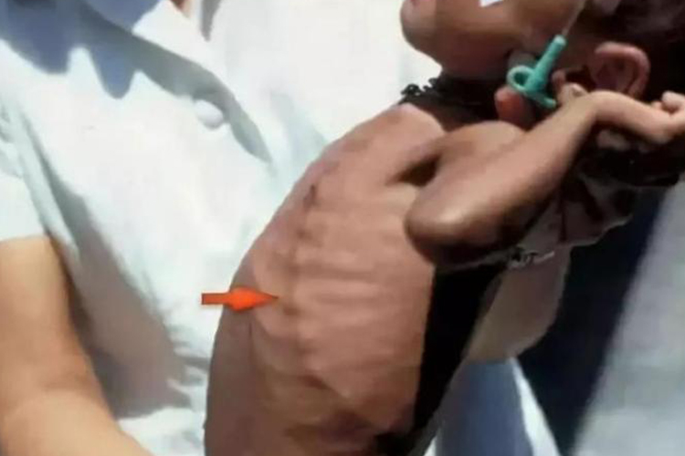 小孩缺钙导致肋骨串珠图