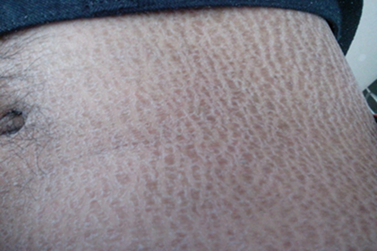 寻常型鱼鳞病腹部竖纹图