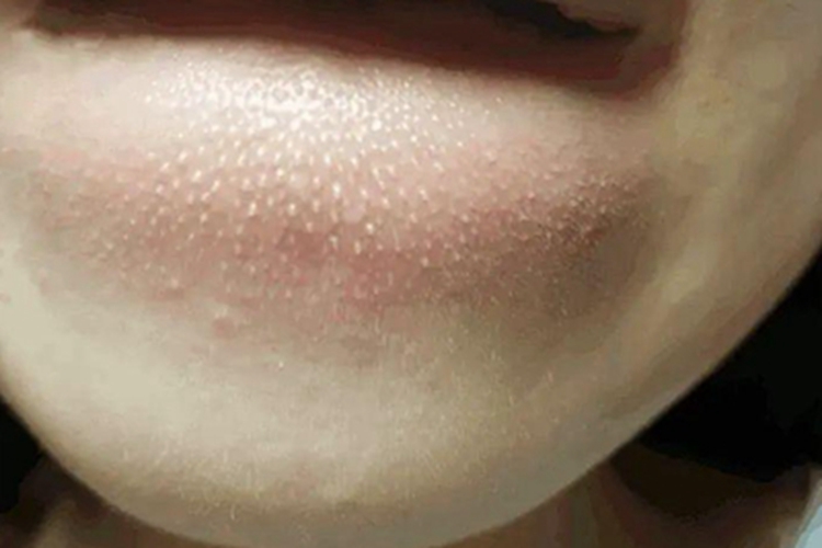 皮脂腺增生下巴症状图 皮脂腺增生下巴症状图