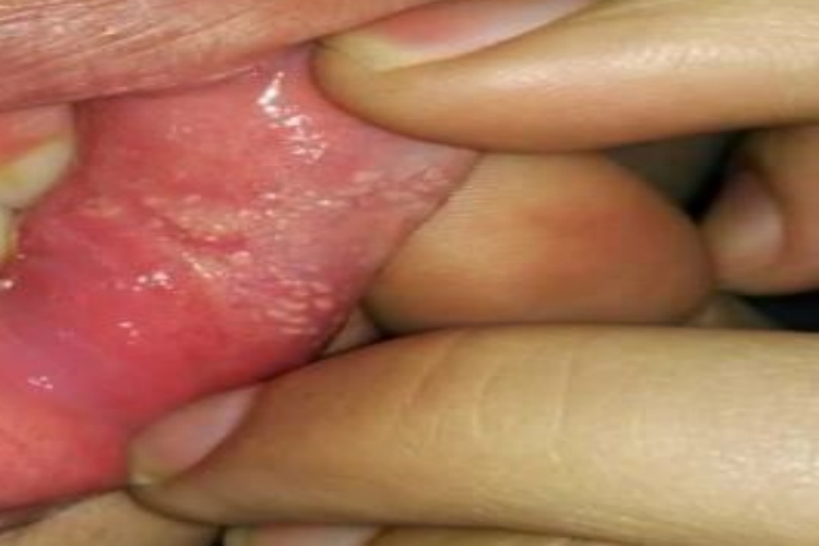 皮脂腺异位症图