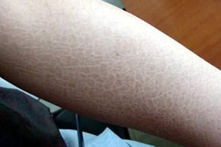 鱼鳞病胳膊皮肤颜色加深图