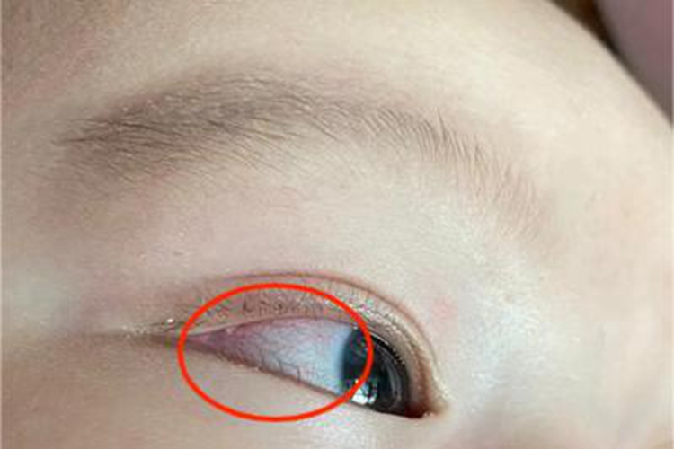 获得性风疹前驱期眼睛有红血丝图