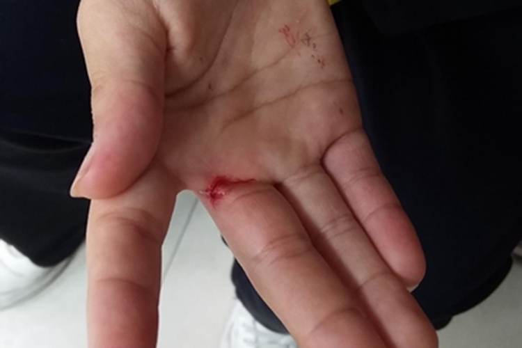 划伤右手指根部出血图 划伤右手指根部出血图
