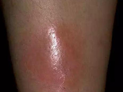 硬红斑小腿表面光滑伴有红肿图