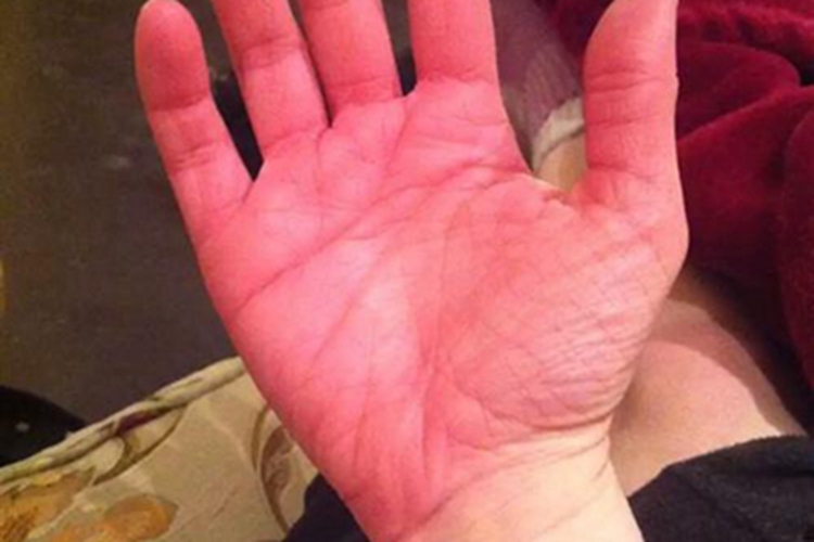 红斑性肢痛症手掌红肿图