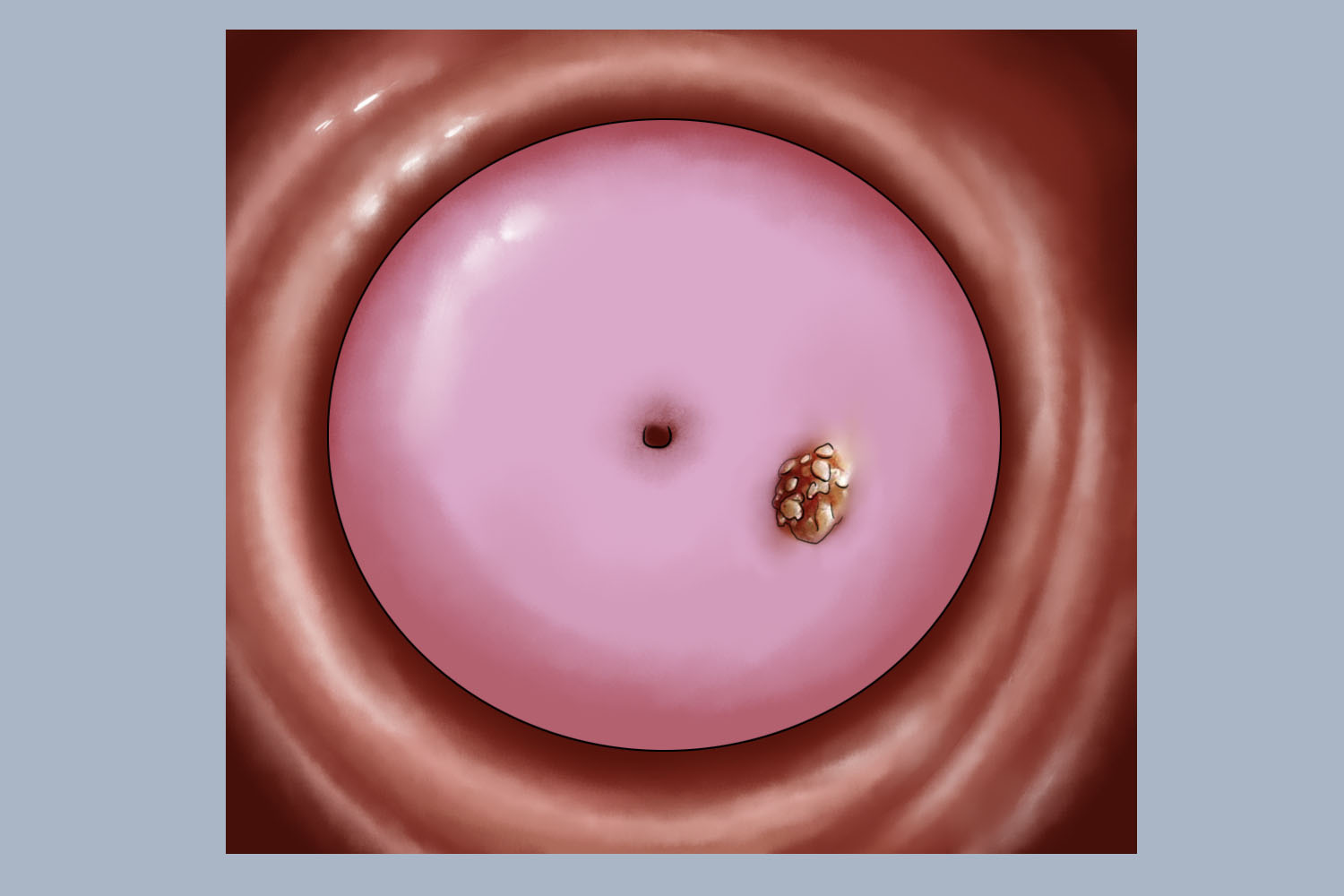 宫颈尖锐湿疣图