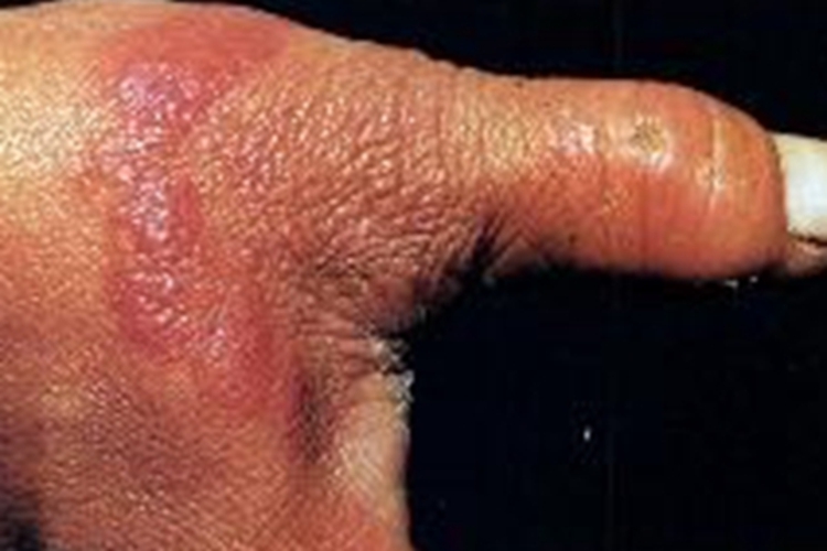 局限型类丹毒虎口上有凸起红斑图