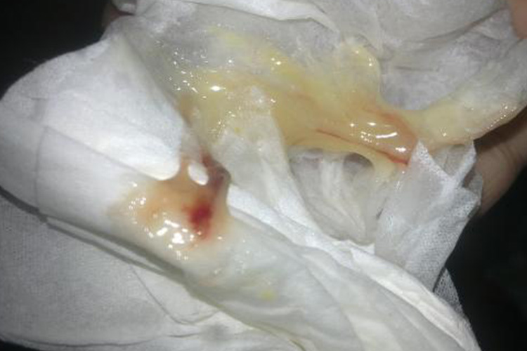 黏液黄浓痰图 黏液黄浓痰图