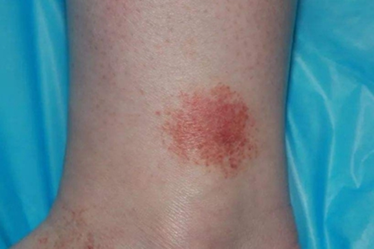 进行性色素性皮肤病脚踝红斑图