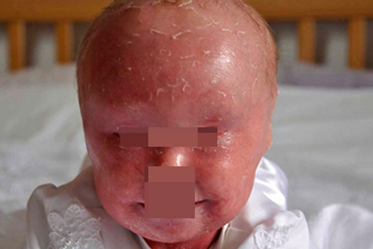 非大疱性鱼鳞病样红皮病症状图