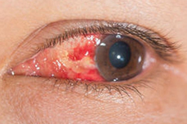 结膜炎结膜充血图