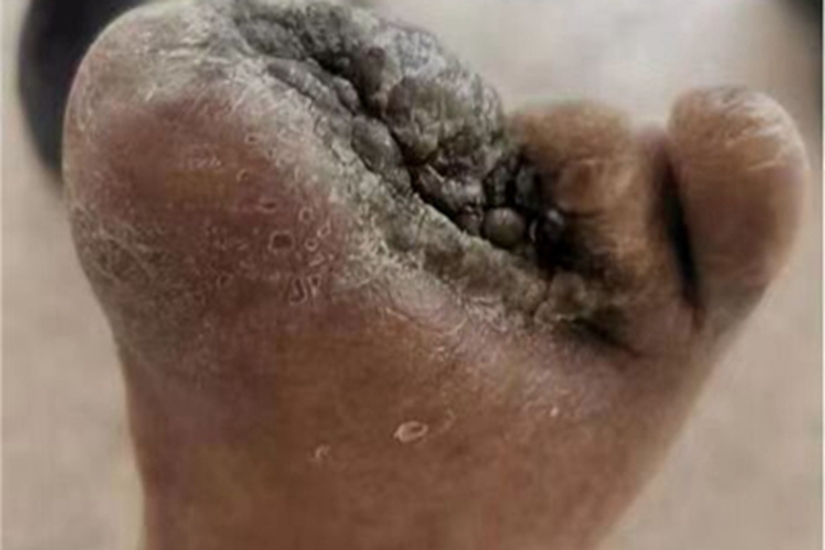 湿性坏疽脚部皮肤发黑图