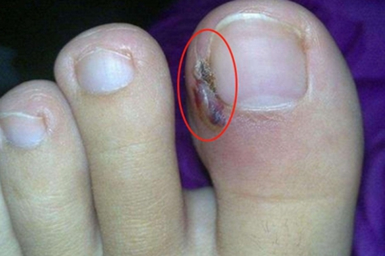 甲床炎脚趾甲症状图 甲床炎脚趾甲症状图