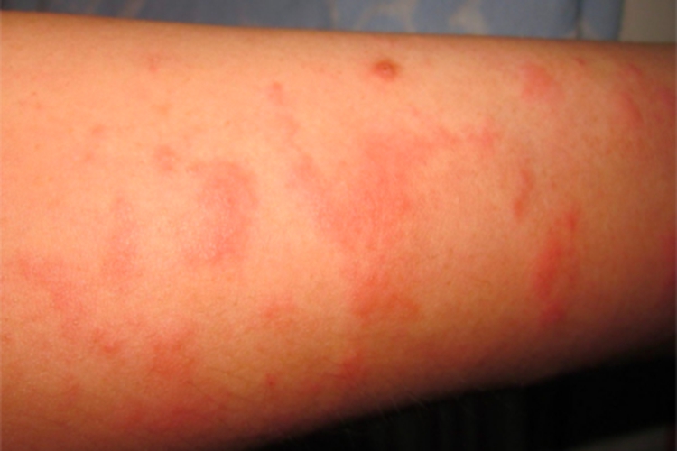 风湿性边缘性红斑胳膊症状图 风湿性边缘性红斑胳膊症状图