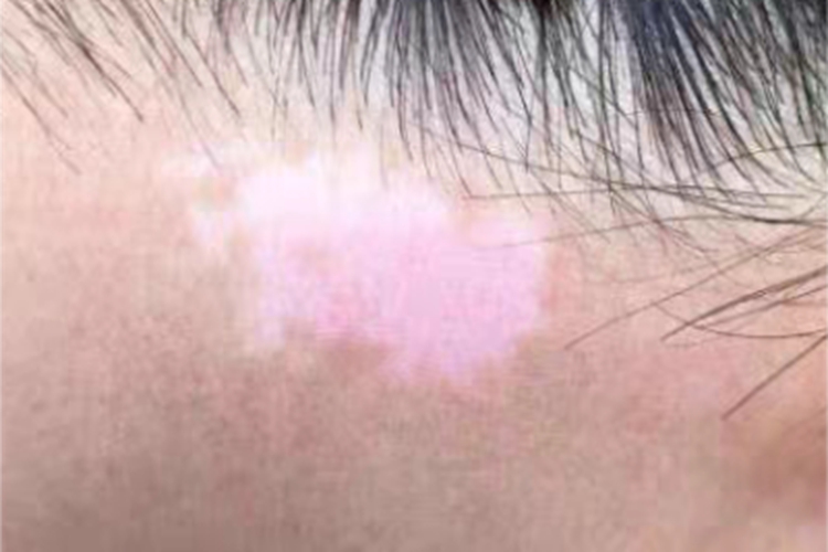 进展期节段型白癜风颈部斑图