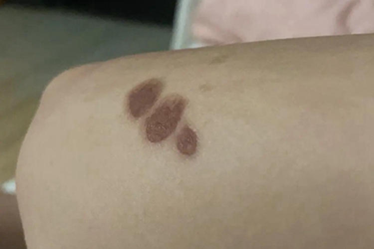 炎症后色素沉着大腿症状图