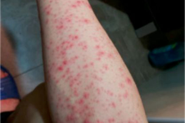 成人Still病胳膊丘疹图 成人Still病胳膊丘疹图