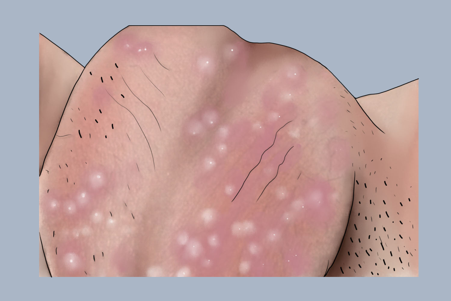 损害可发生在阴囊,临床可表现为局部出现囊性丘疹或结节,表面皮肤正常