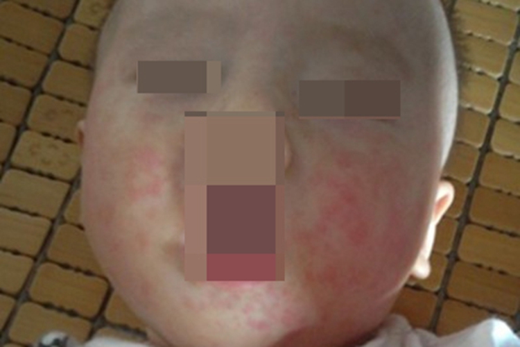 麻疹面部红色斑丘疹图