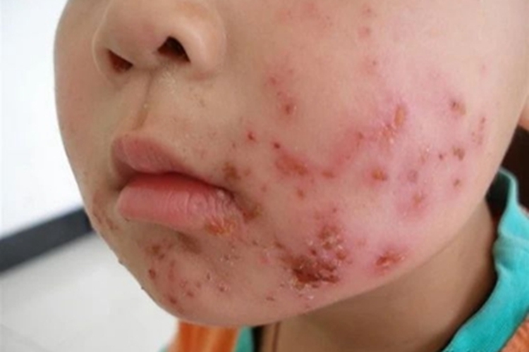 脓疱疮面部黄痂图 脓疱疮面部黄痂图