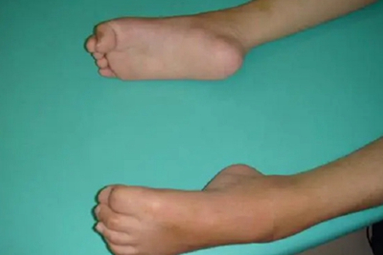 先天性多关节挛缩症脚部症状图