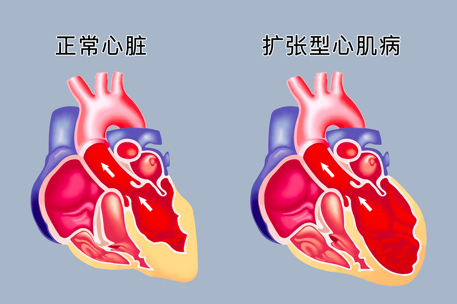 扩张型心肌病心腔扩大图