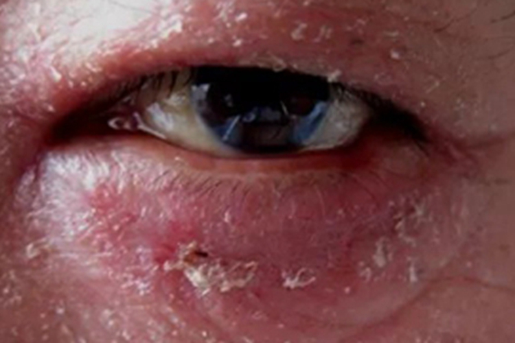 溃疡性睑缘炎红肿图 溃疡性睑缘炎红肿图
