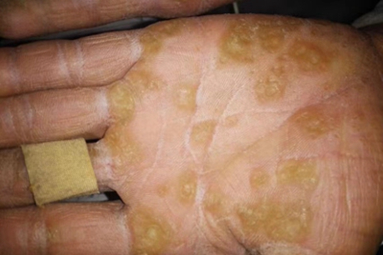 掌跖角化病手掌皮肤增厚图 掌跖角化病手掌皮肤增厚图