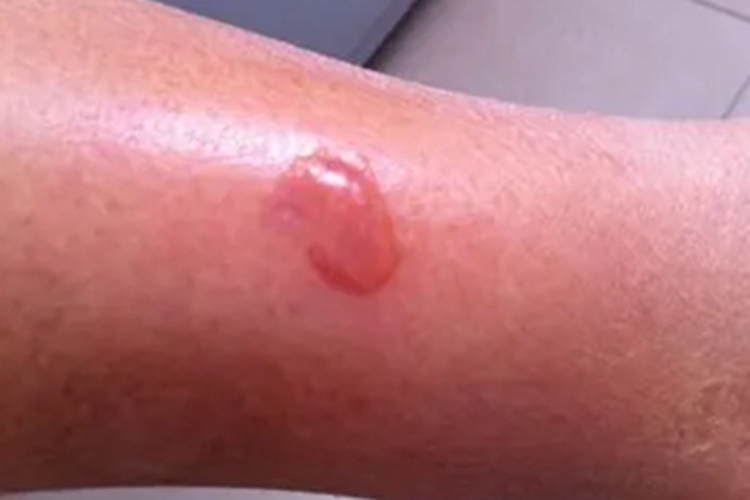 热带溃疡小腿水疱图