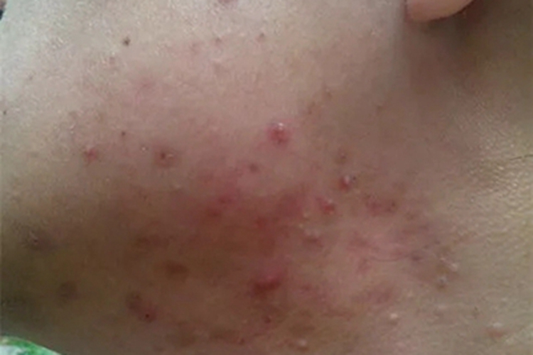 嗜酸性脓疱性毛囊炎下巴丘疹图