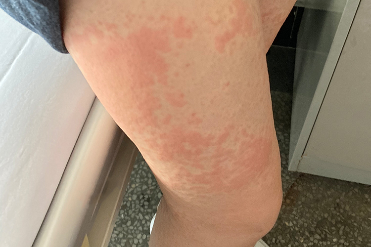 硬性丘疹伴风团样肿大皮损图