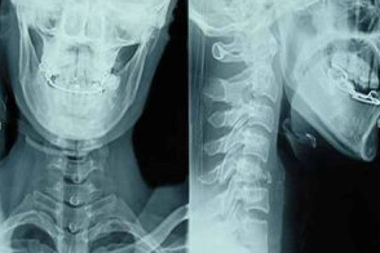 颈椎半脱位X线图