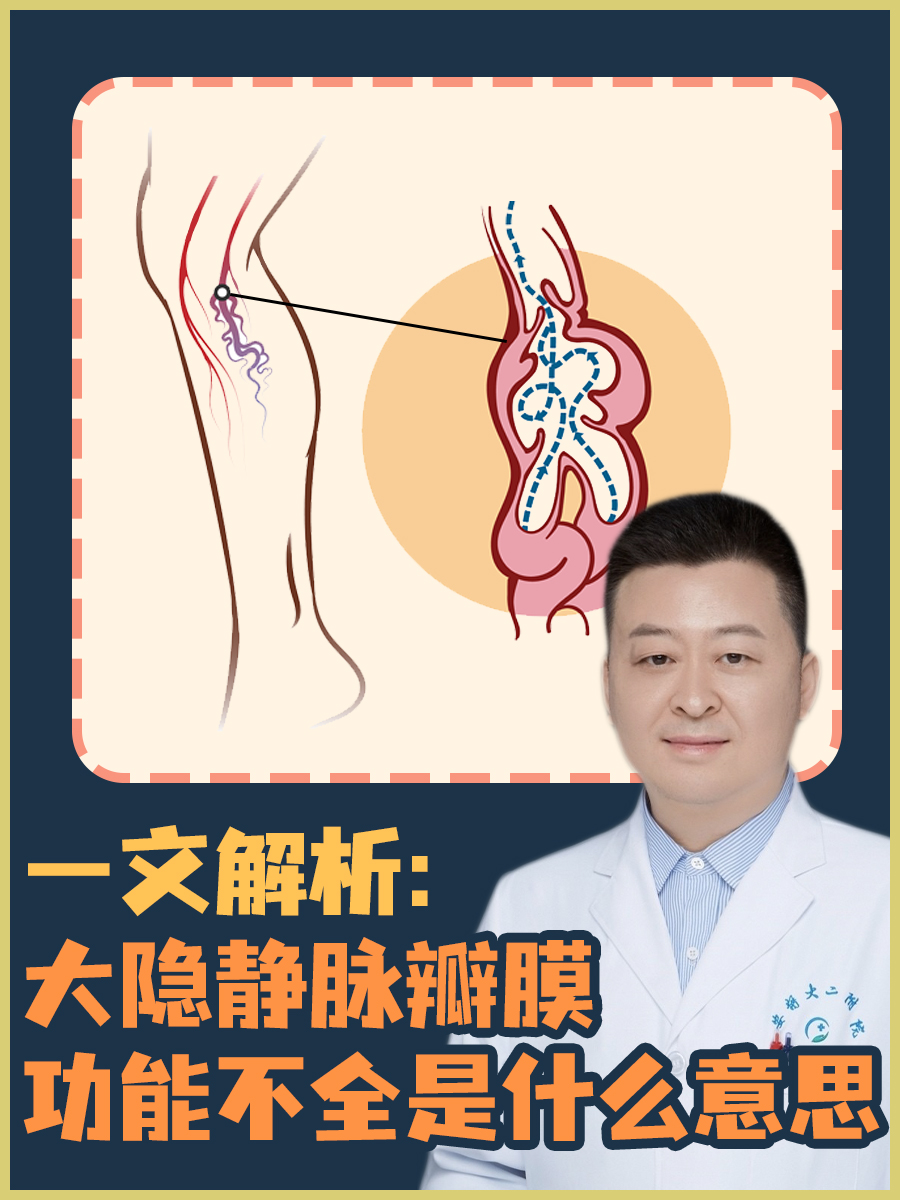 一文解析：大隐静脉瓣膜功能不全是什么意思