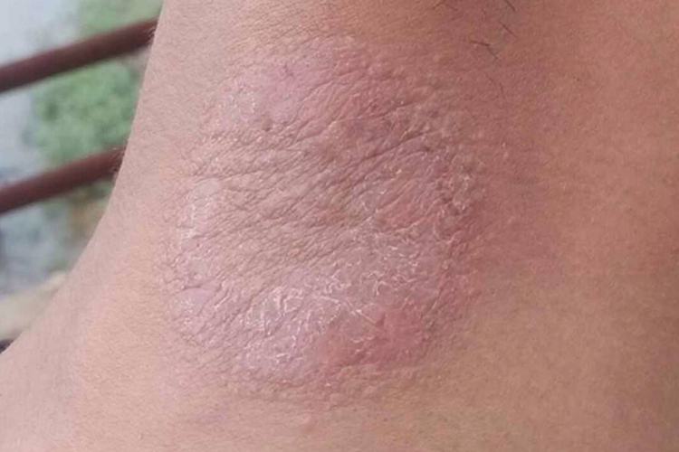 脖子体癣图 脖子体癣图