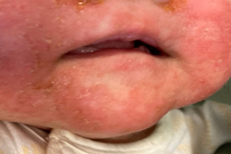 急性湿疹下巴长红斑图