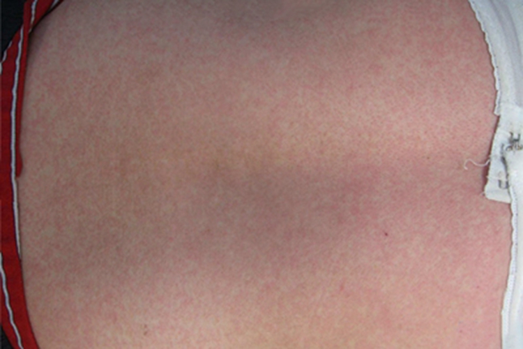 风疹背部症状图