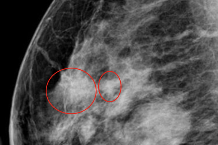 乳腺增生乳房结节影像学图