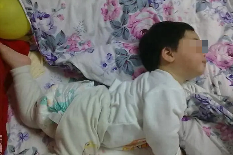 脑瘫肌张力高角弓反张图