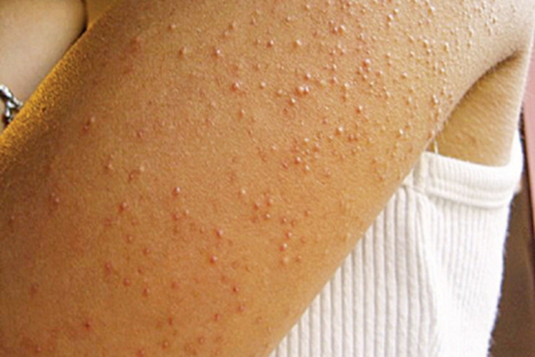 全身性瘙痒症胳膊丘疹图