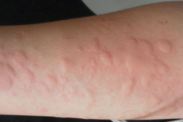 伊曲康唑胶囊过敏荨麻疹图