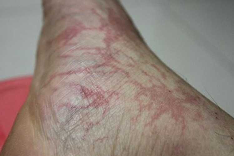 四肢血栓性浅静脉炎症状图