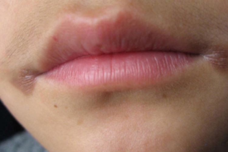 感染性口角唇炎慢性期症状图