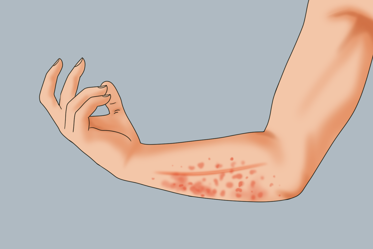 手臂上接触性皮炎图 手臂上接触性皮炎图