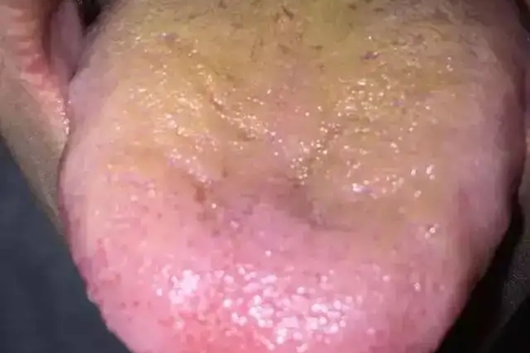 肝阳上亢舌象图